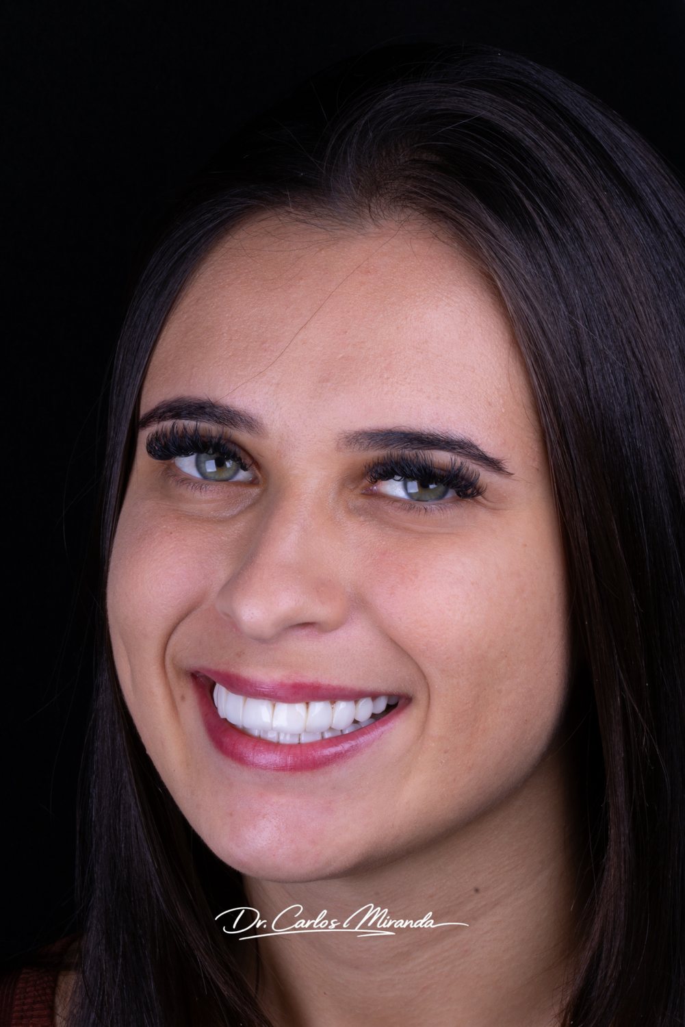Sorriso reabilitado com facetas em resina