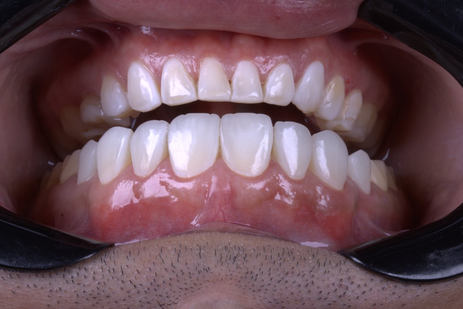 Detalhe clínico de sorriso reabilitado