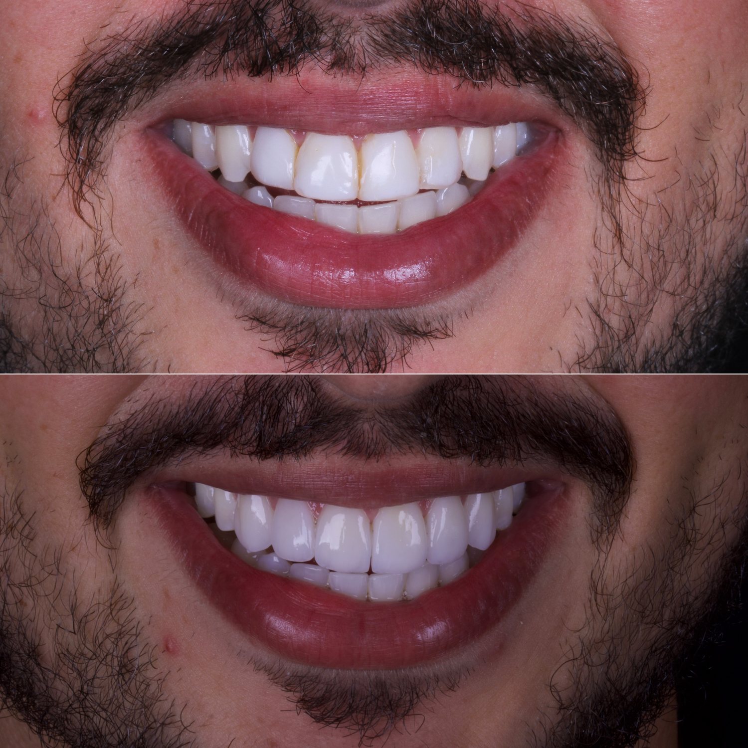 Detalhe de sorriso reabilitado em porcelana — antes (acima) e depois (abaixo)