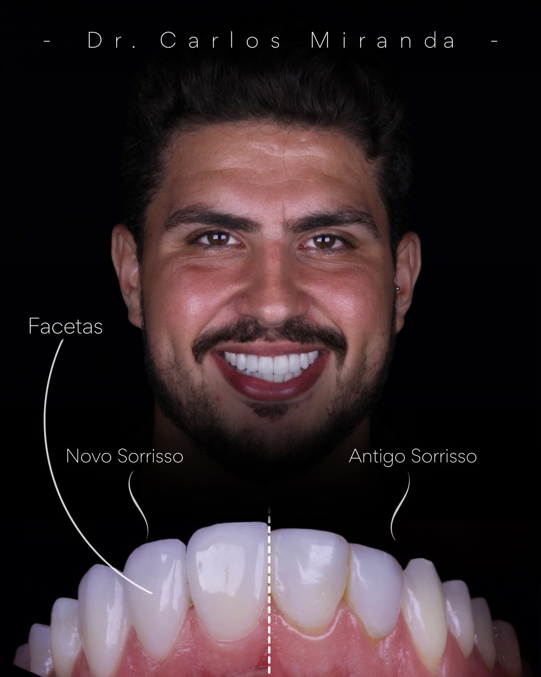 Caso de facetas — comparativo antes e depois