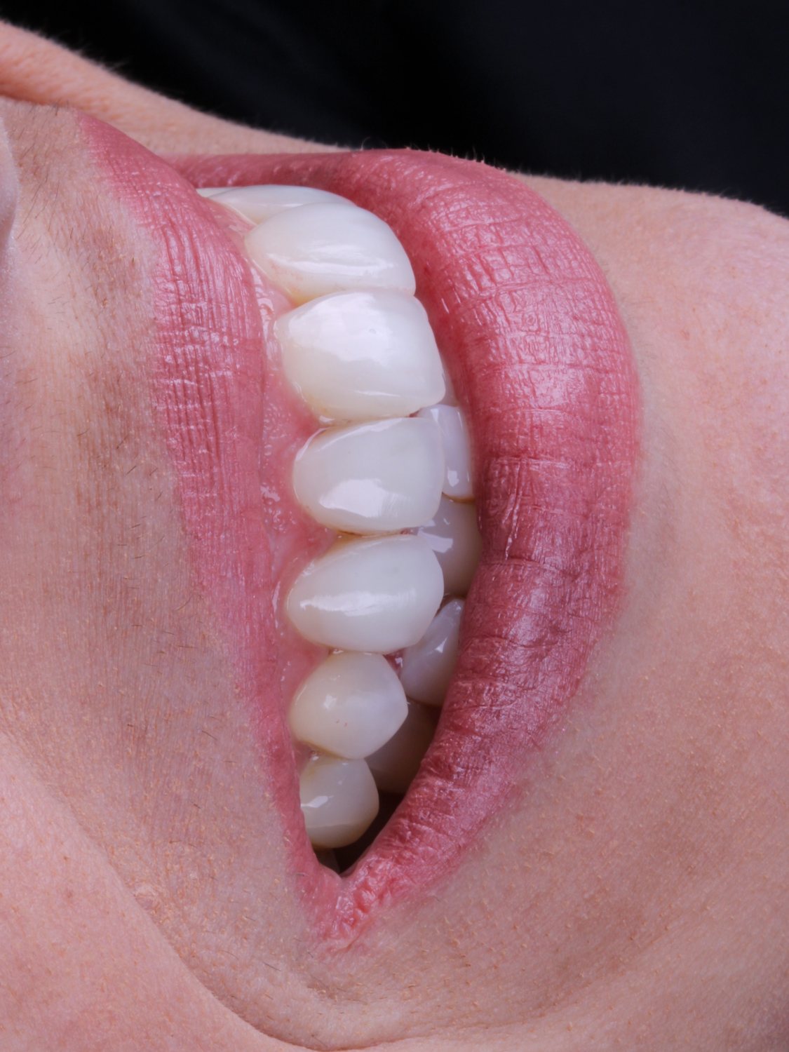Detalhe de sorriso reabilitado em porcelana — vista lateral