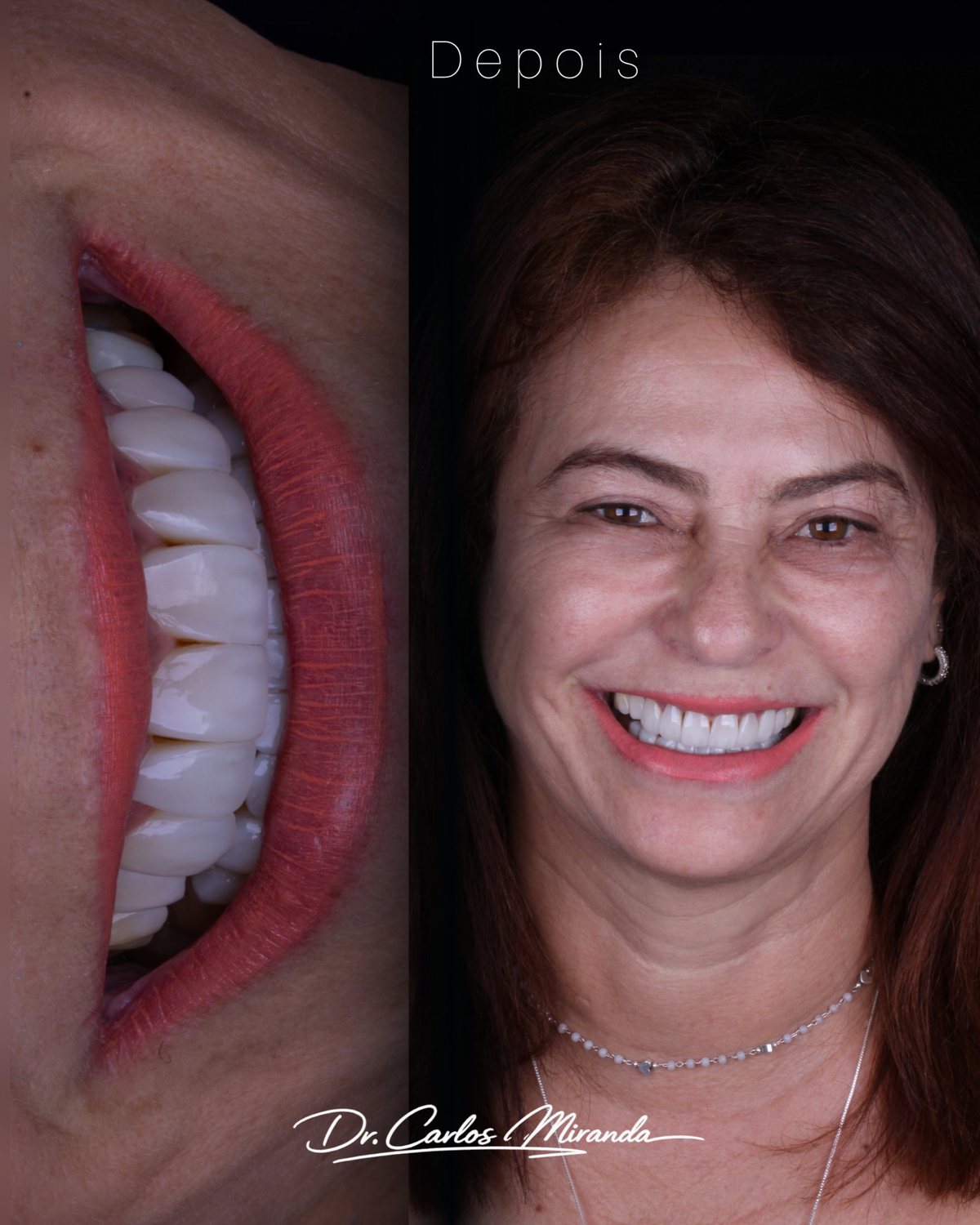 Resultado de reabilitação estética em paciente