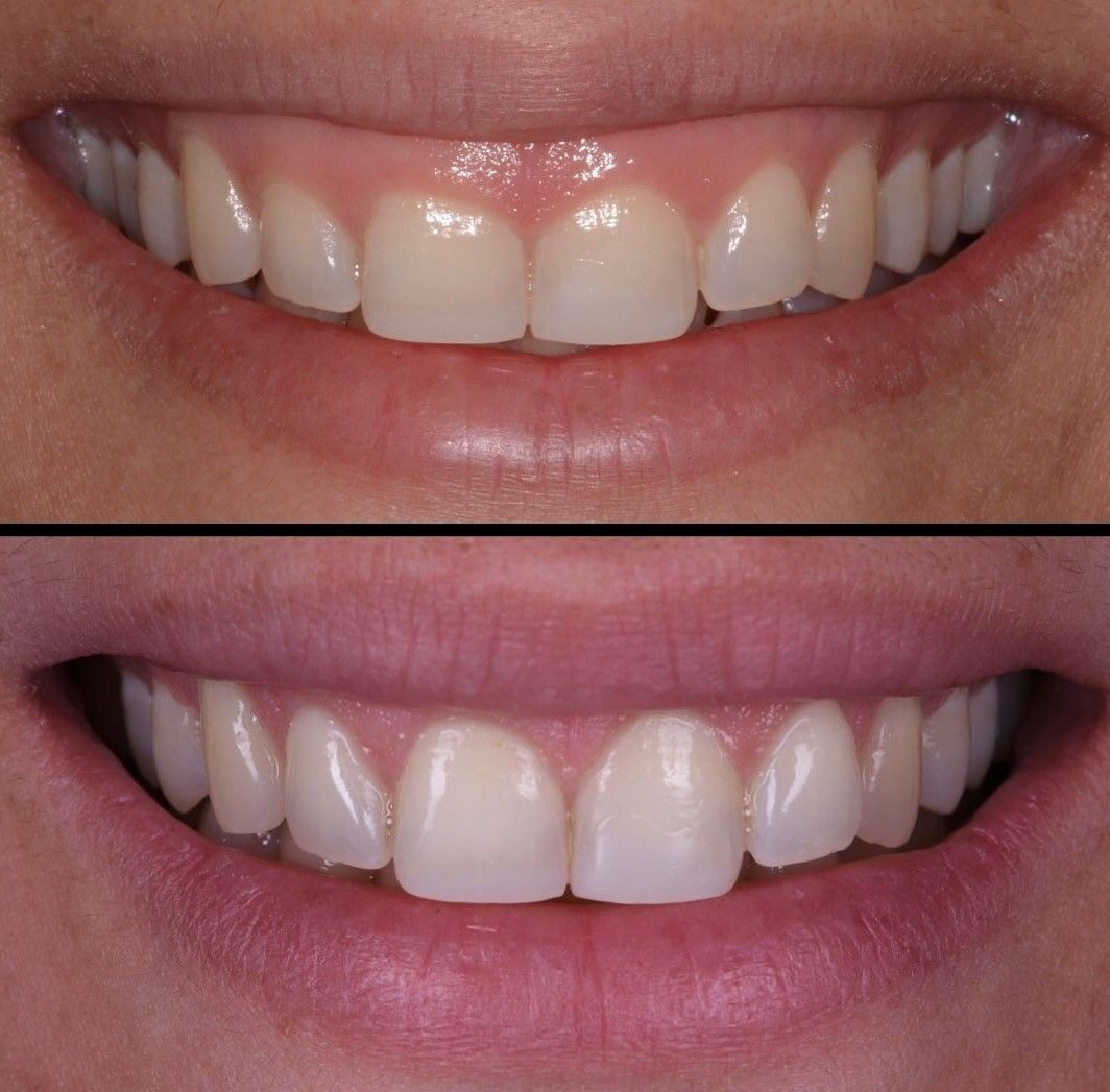 Gengivoplastia — antes e depois do sorriso de uma paciente, contorno da gengiva, Dr. Carlos Miranda
