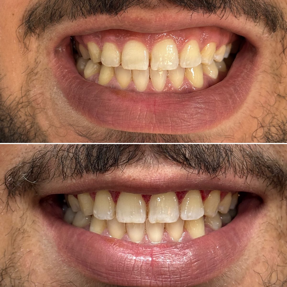 Gengivoplastia — antes e depois do sorriso de um paciente, contorno da gengiva, Dr. Carlos Miranda