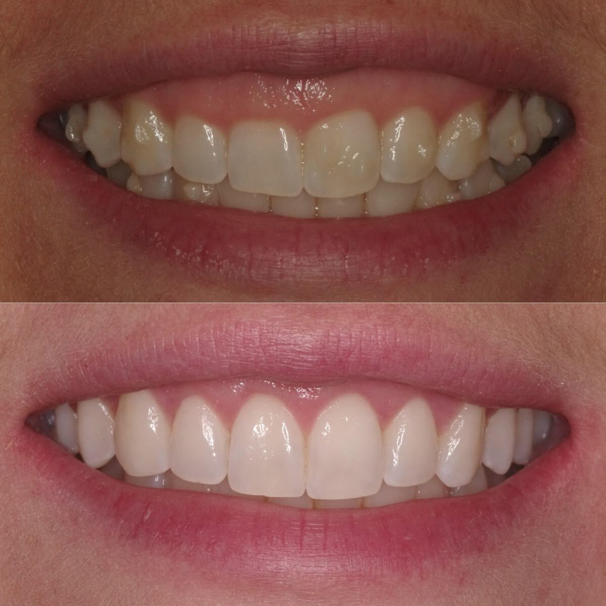 Gengivoplastia — antes e depois do sorriso, harmonização da gengiva, Dr. Carlos Miranda