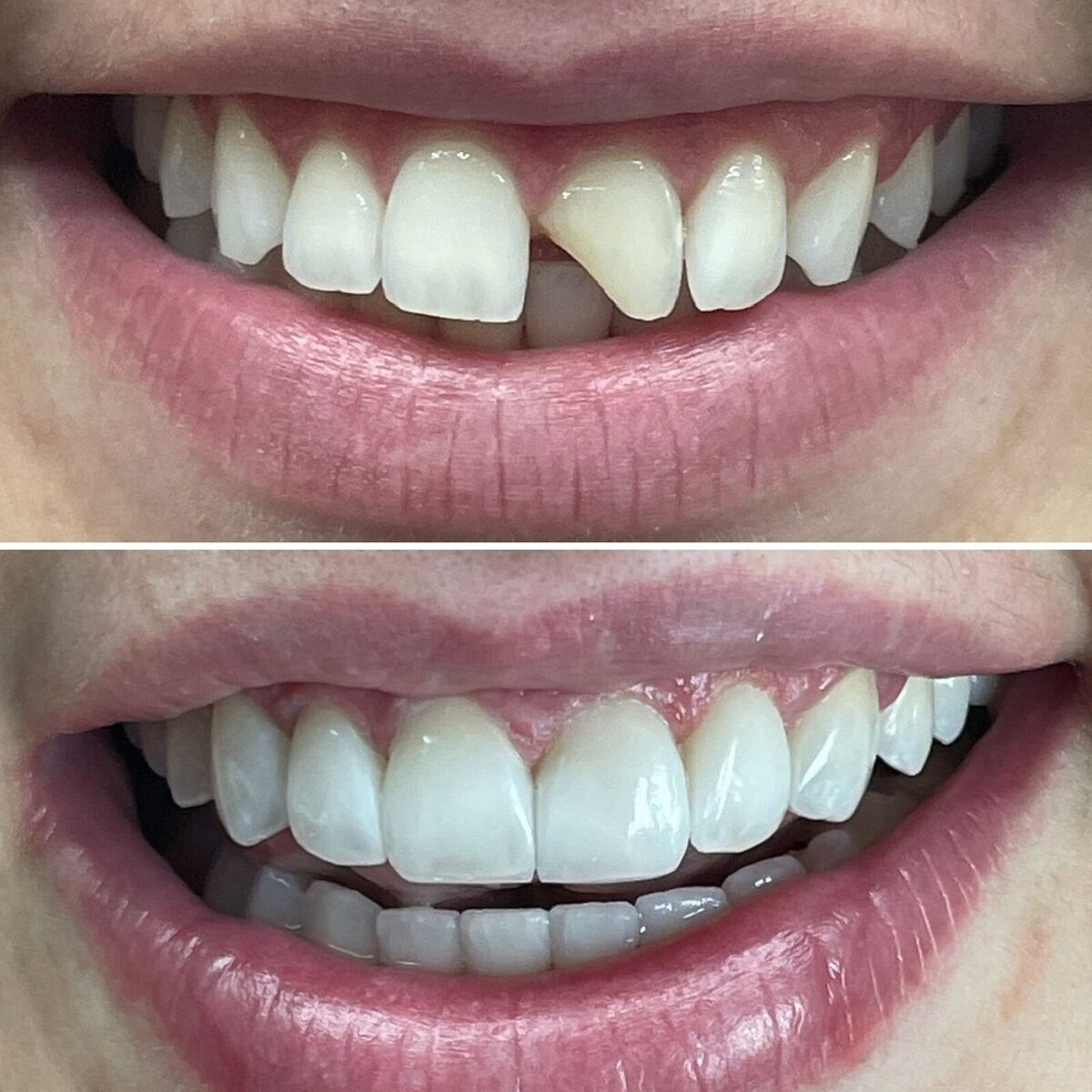 Restauração estética — fechamento de espaço entre os dentes, antes e depois, Dr. Carlos Miranda