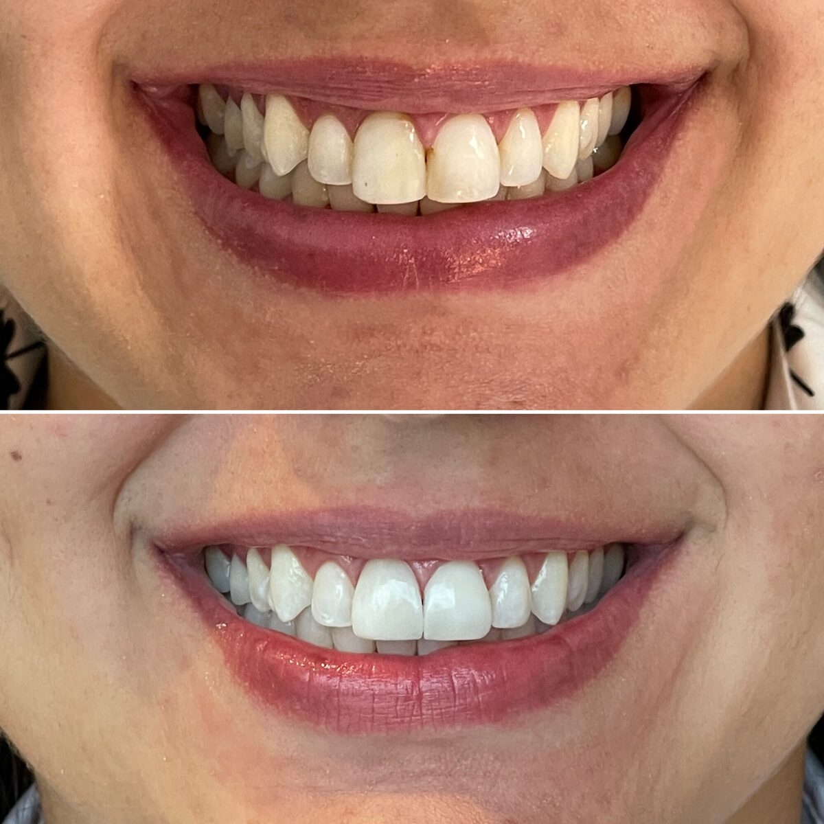 Clareamento dental — antes e depois do sorriso de uma paciente, Dr. Carlos Miranda