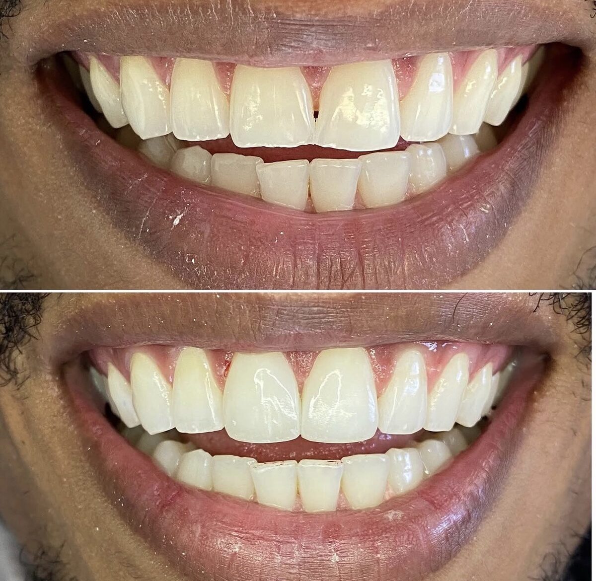 Restauração estética — sorriso restaurado, antes e depois, Dr. Carlos Miranda