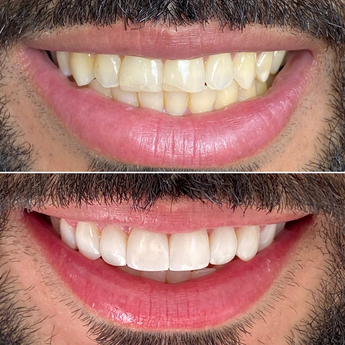 Clareamento dental — antes e depois do sorriso de um paciente, Dr. Carlos Miranda