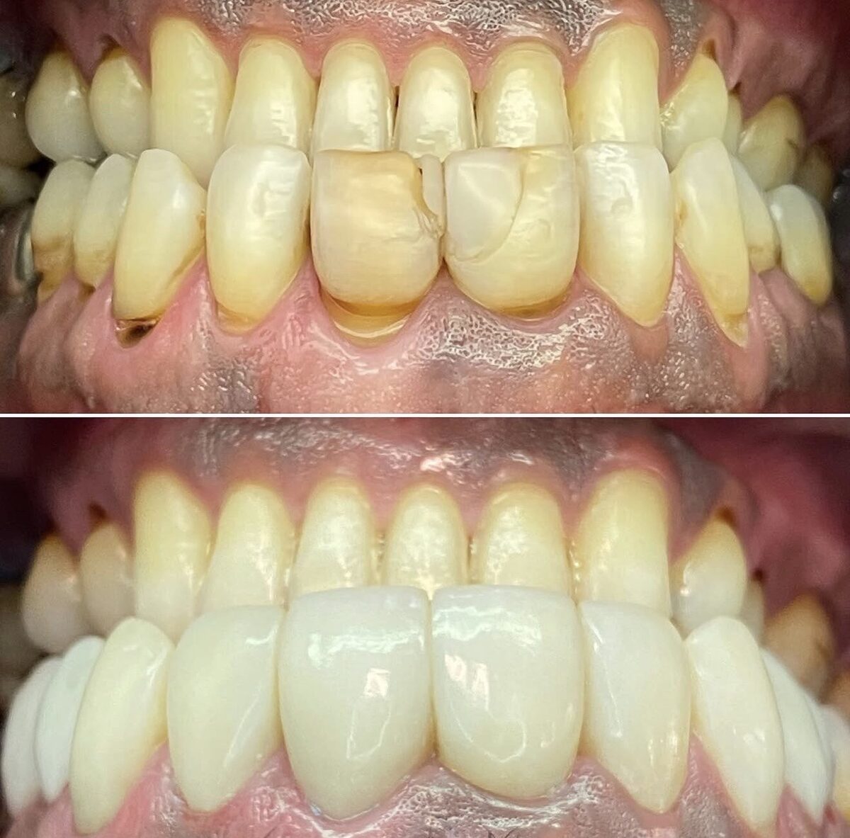 Restaurações estéticas — reabilitação de dentes anteriores, antes e depois, Dr. Carlos Miranda