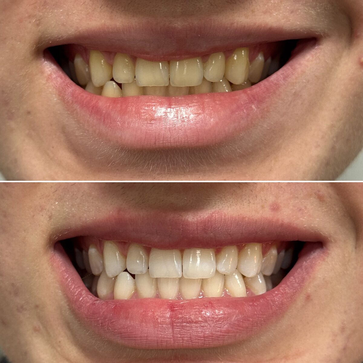 Clareamento dental — sorriso renovado, antes e depois, Dr. Carlos Miranda