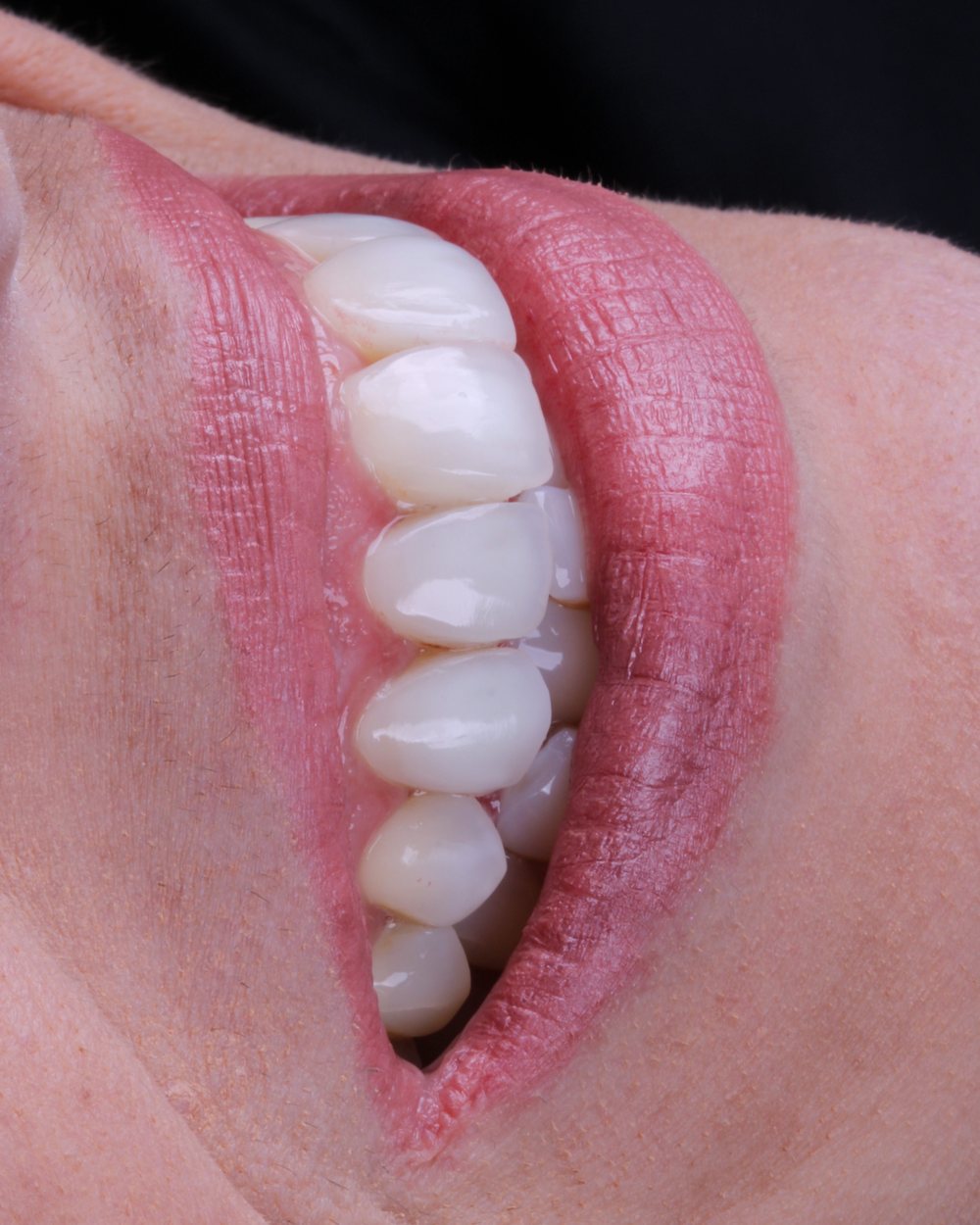 Detalhe de sorriso reabilitado em porcelana, conduzido pelo Dr. Carlos Miranda