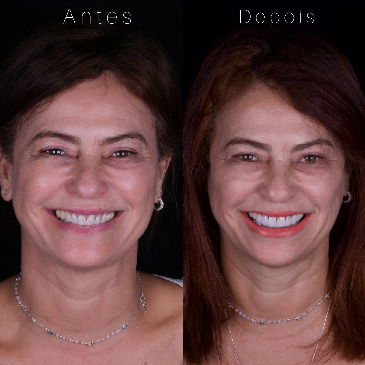 Facetas em resina — antes e depois do sorriso de uma paciente, Dr. Carlos Miranda