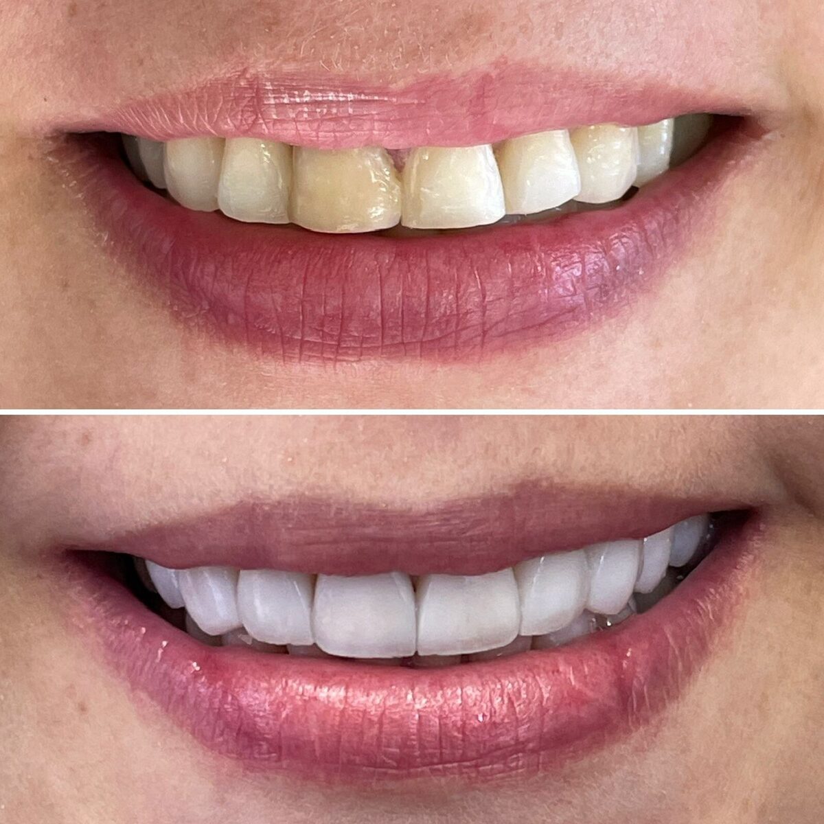 Facetas em resina — detalhe do antes e depois dos dentes, Dr. Carlos Miranda
