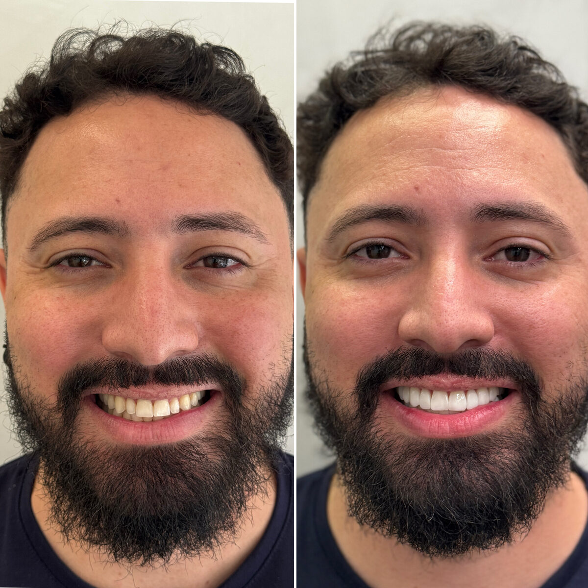 Facetas em resina — antes e depois do sorriso de um paciente, Dr. Carlos Miranda