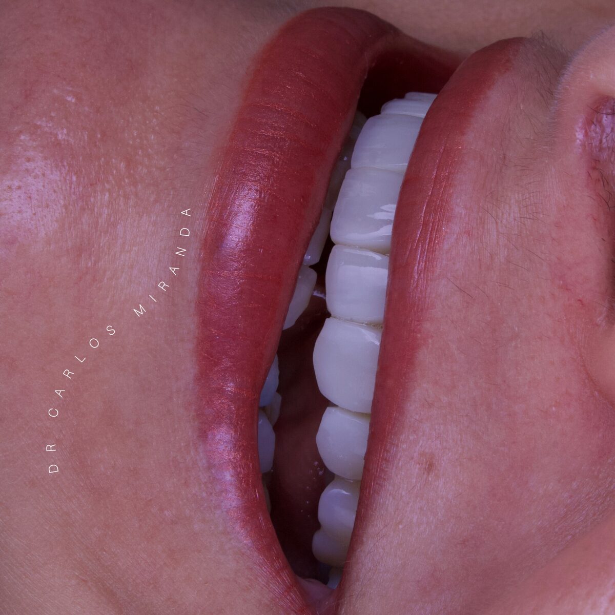 Facetas em resina — fechamento de espaço entre os dentes, antes e depois, Dr. Carlos Miranda