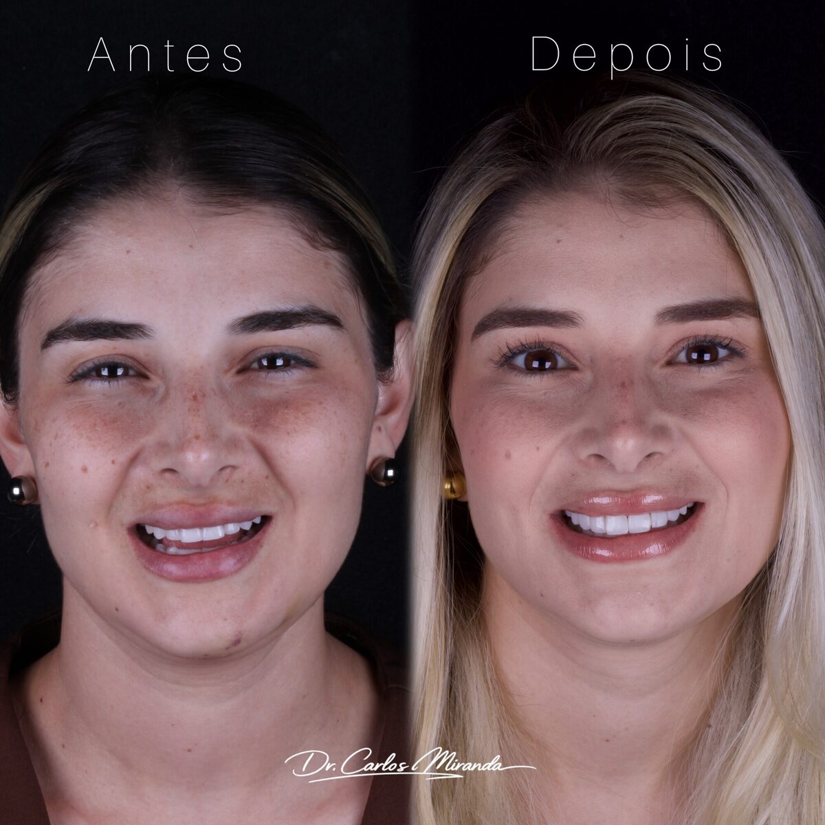 Facetas em resina — antes e depois do sorriso de uma paciente jovem, Dr. Carlos Miranda