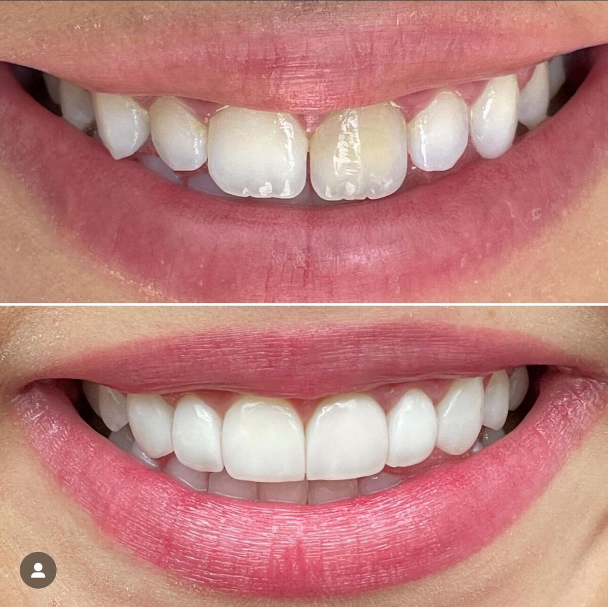 Facetas em resina — detalhe do antes e depois dos dentes anteriores, Dr. Carlos Miranda