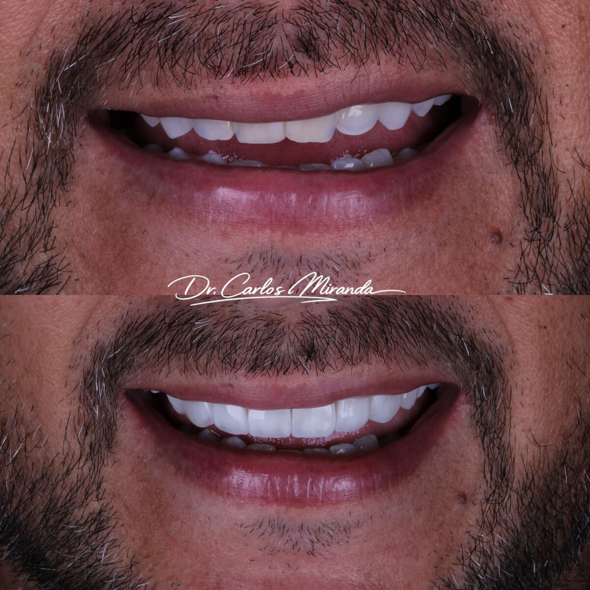 Facetas em resina — antes e depois do sorriso de um paciente, Dr. Carlos Miranda