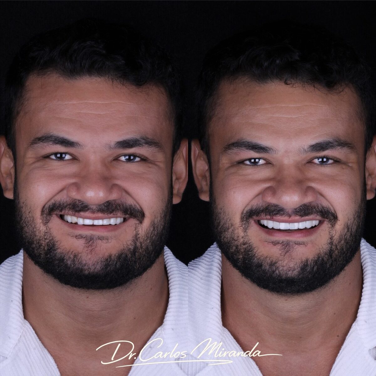 Facetas em resina — antes e depois do sorriso de um paciente, Dr. Carlos Miranda