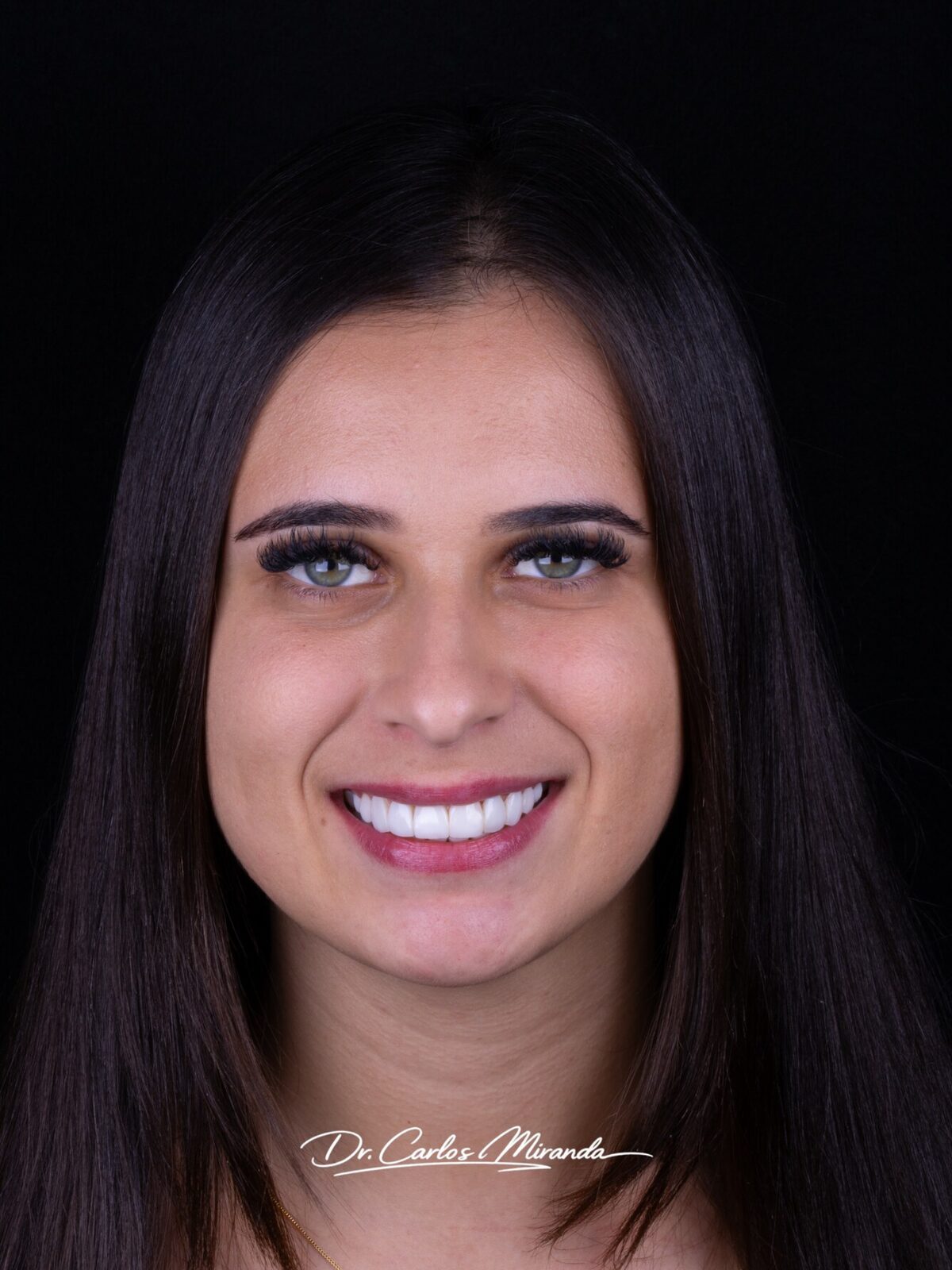 Sorriso natural renovado com facetas em resina — caso do Dr. Carlos Miranda
