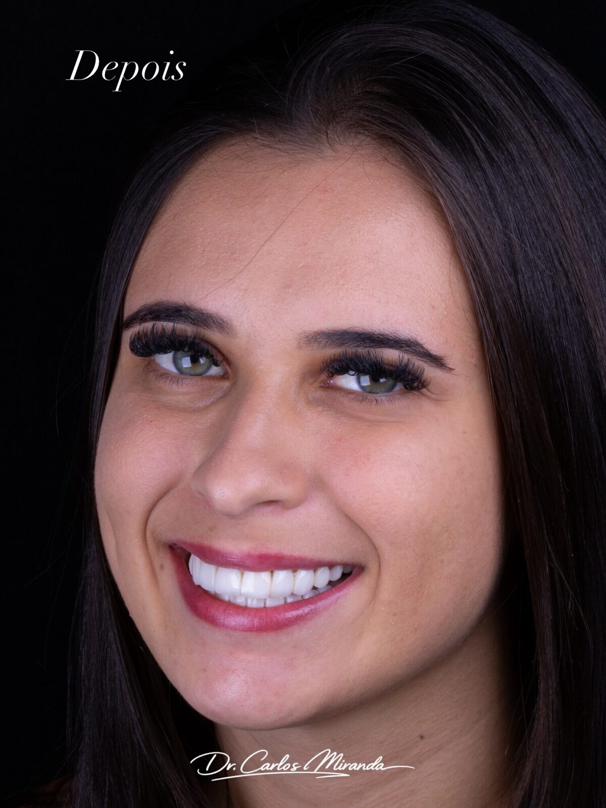 Resultado de facetas em resina — sorriso harmônico, Dr. Carlos Miranda