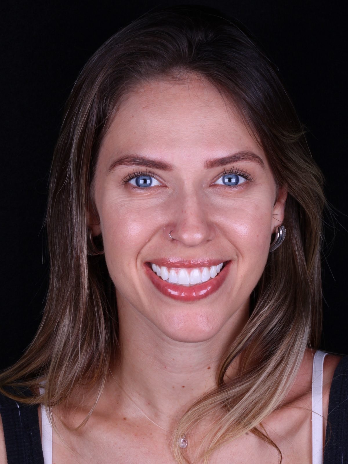 Paciente com sorriso natural após tratamento estético