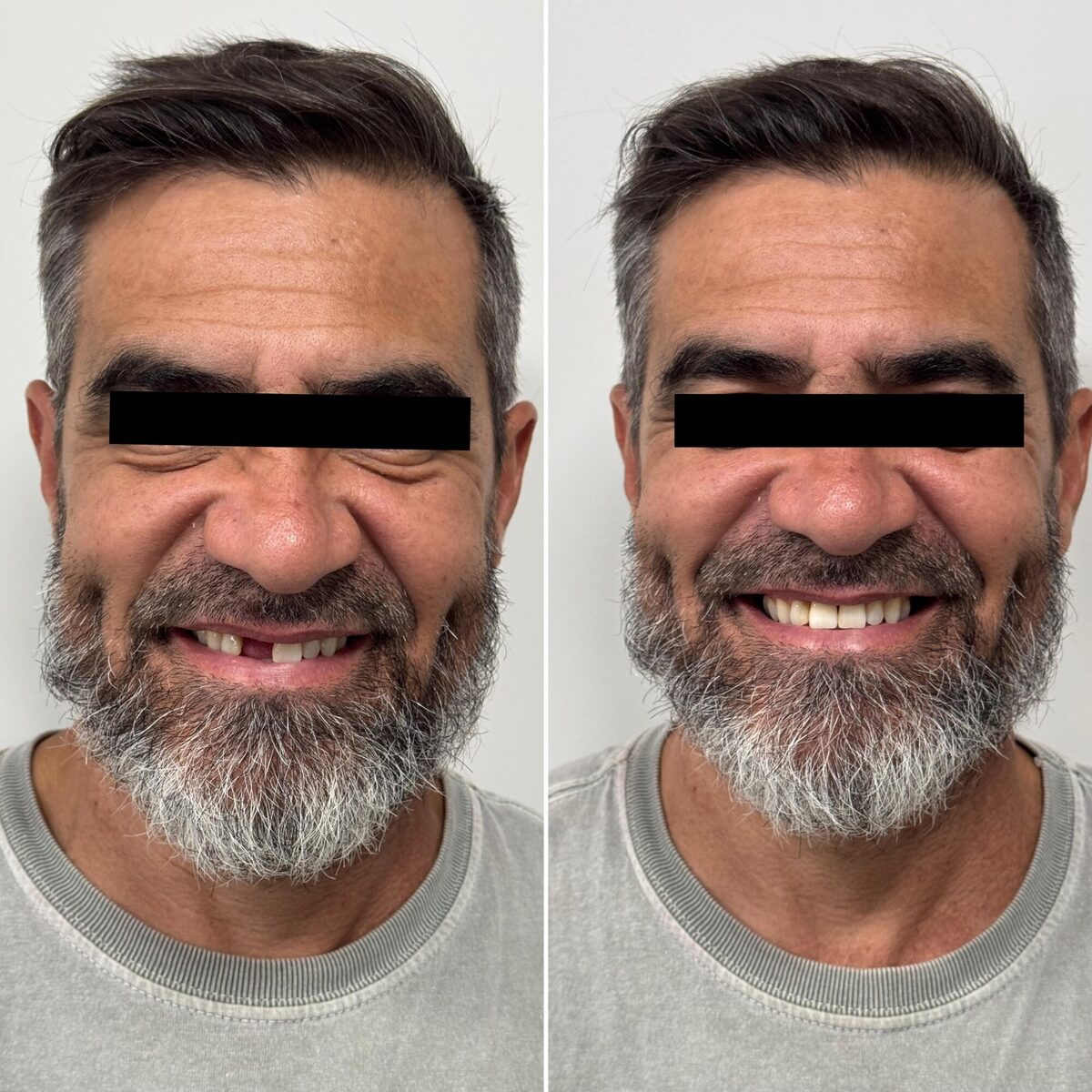 Implante dentário — antes e depois do sorriso de um paciente reabilitado, Dr. Carlos Miranda