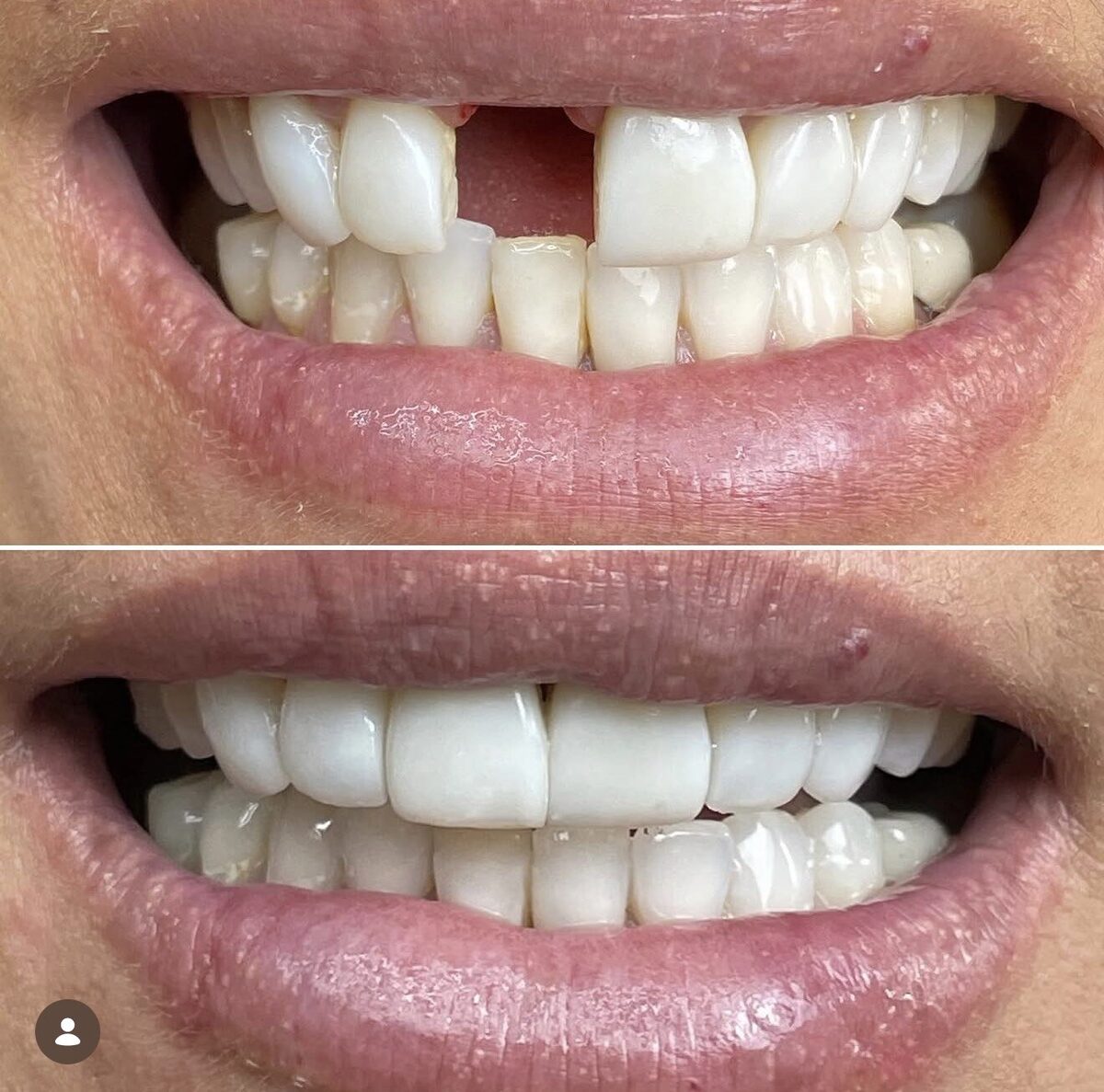 Implante dentário — dente da frente reposto, antes e depois, Dr. Carlos Miranda
