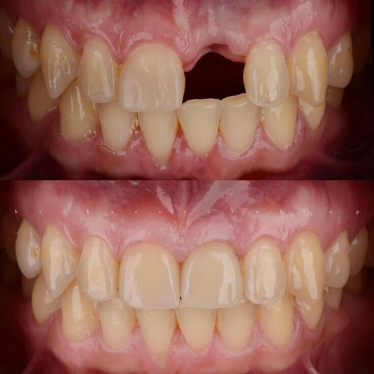 Implante dentário — dente ausente reposto, antes e depois, Dr. Carlos Miranda