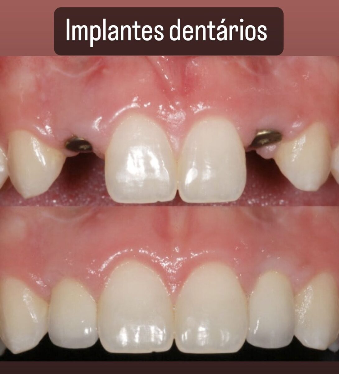Implante dentário — reposição de dente ausente, antes e depois, Dr. Carlos Miranda