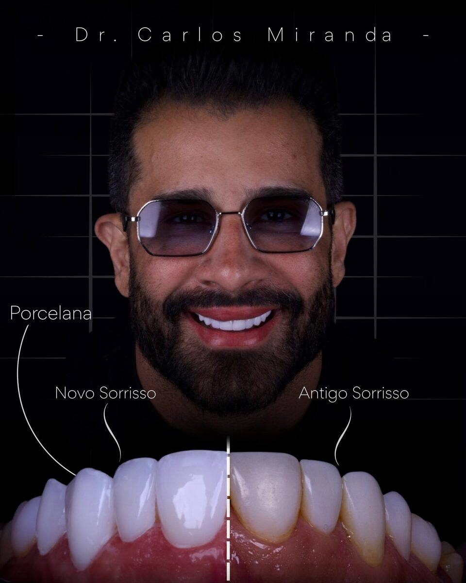 Lentes em porcelana — antigo sorriso e novo sorriso, caso do Dr. Carlos Miranda