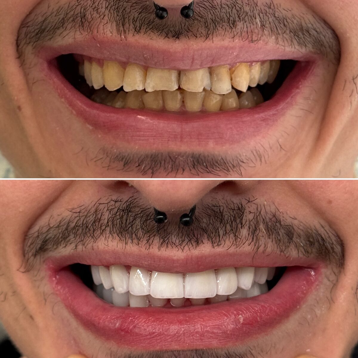 Lentes em porcelana — detalhe do antes e depois dos dentes, Dr. Carlos Miranda