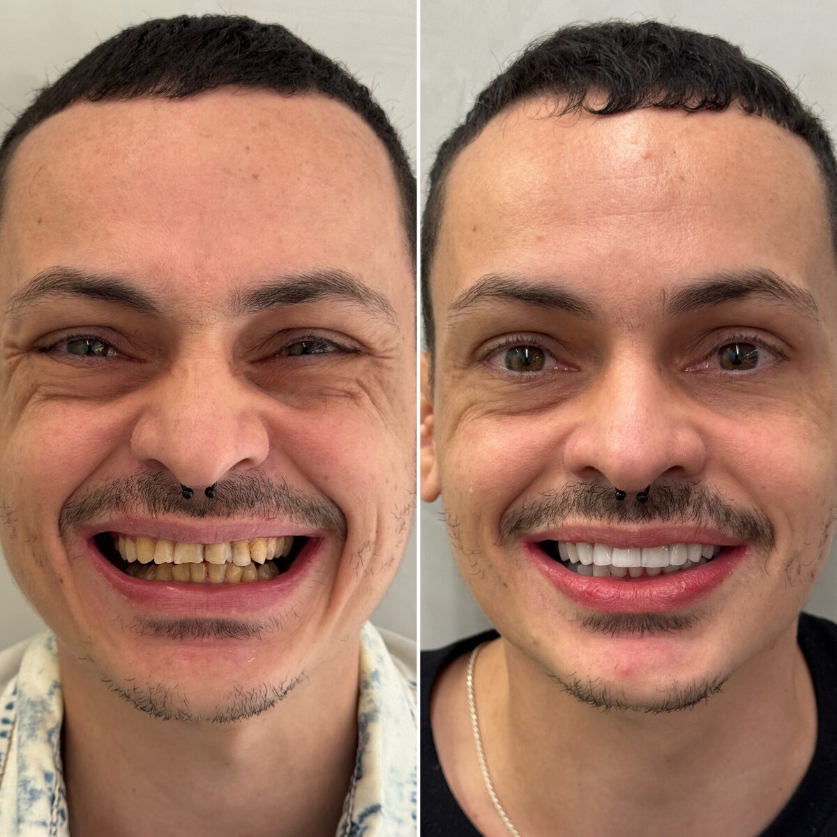 Lentes em porcelana — antes e depois do sorriso de um paciente, Dr. Carlos Miranda