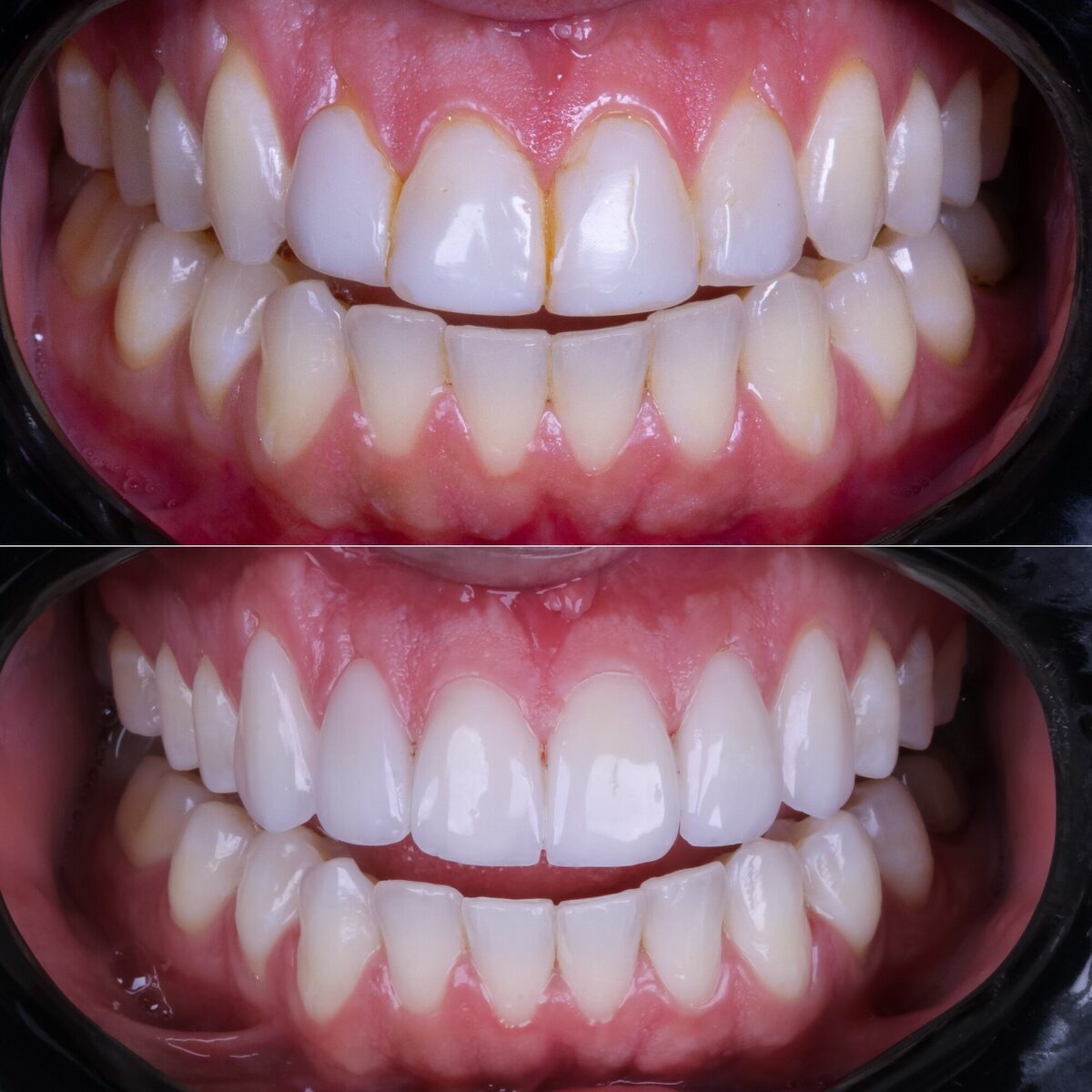 Lentes em porcelana — detalhe do antes e depois dos dentes anteriores, Dr. Carlos Miranda