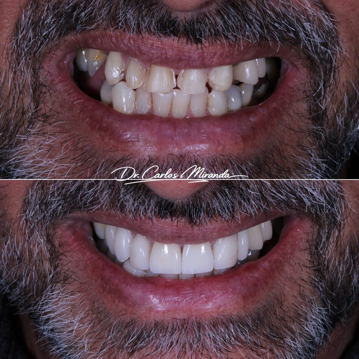 Lentes em porcelana — antes e depois do sorriso de um paciente, Dr. Carlos Miranda