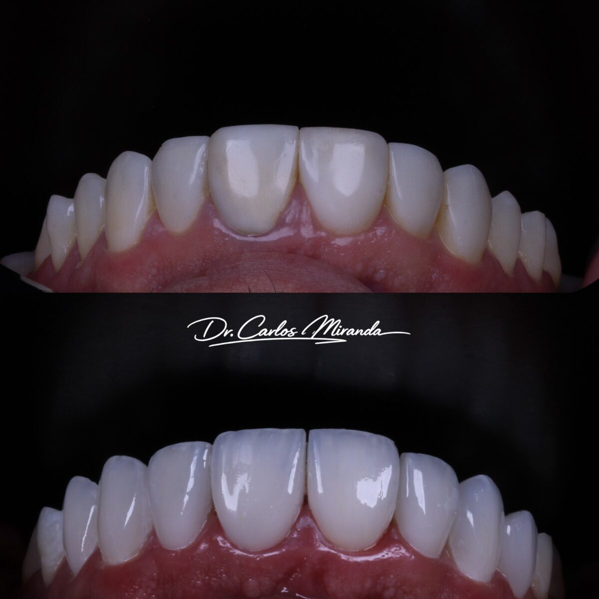 Lentes em porcelana — detalhe do antes e depois do sorriso, Dr. Carlos Miranda