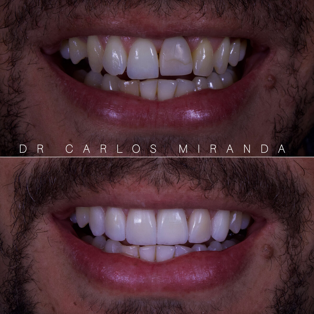 Lentes em porcelana — detalhe do antes e depois dos dentes, Dr. Carlos Miranda