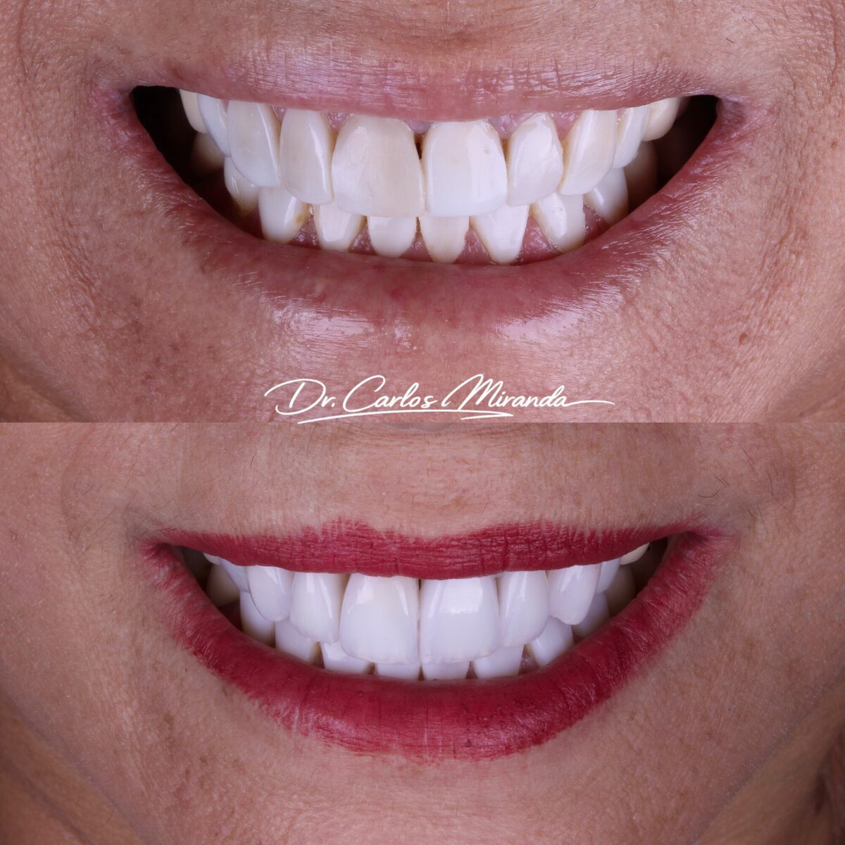 Lentes em porcelana — detalhe do antes e depois dos dentes, Dr. Carlos Miranda