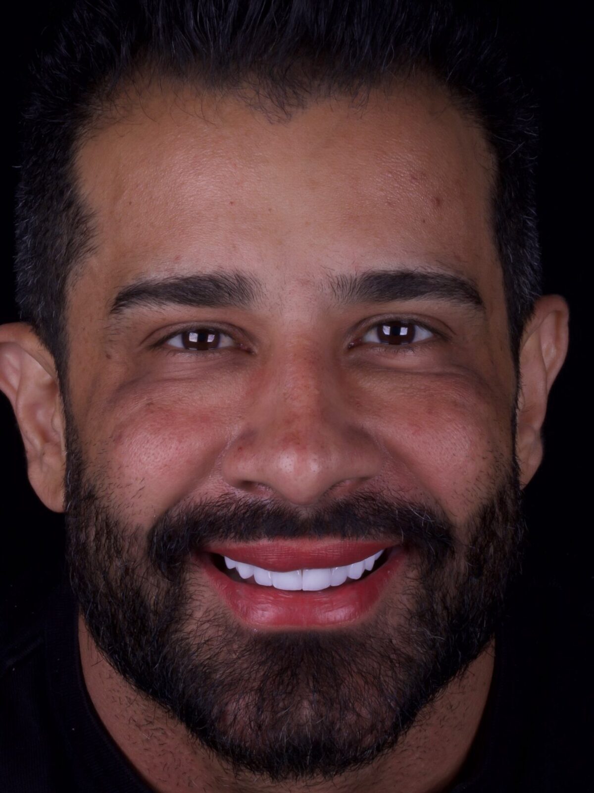 Resultado de lentes em porcelana — sorriso harmônico, Dr. Carlos Miranda