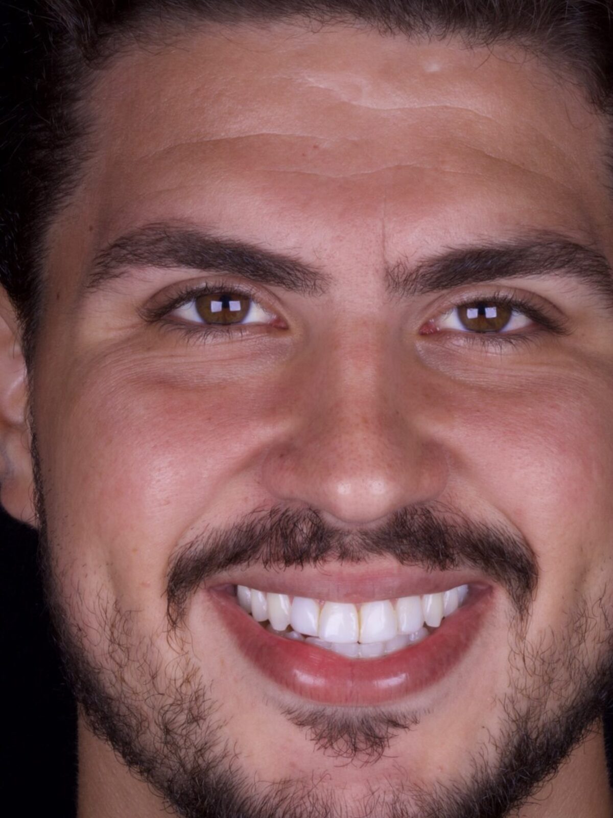 Lentes em porcelana — sorriso natural e branco, caso do Dr. Carlos Miranda