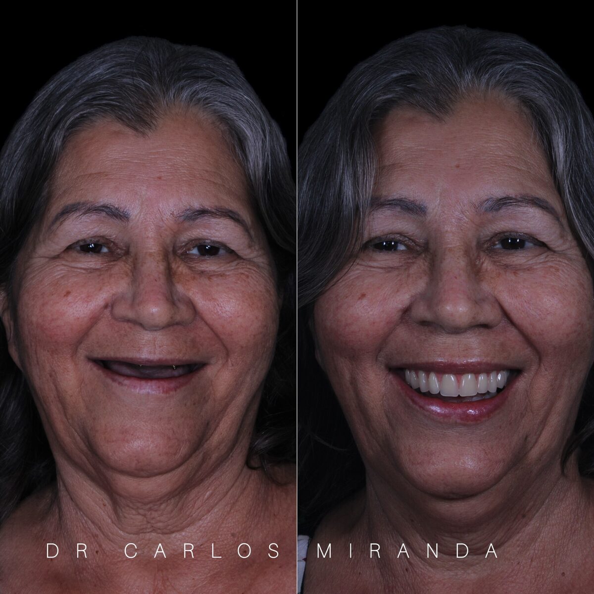 Protocolo sobre implante — antes e depois do sorriso de uma paciente, Dr. Carlos Miranda