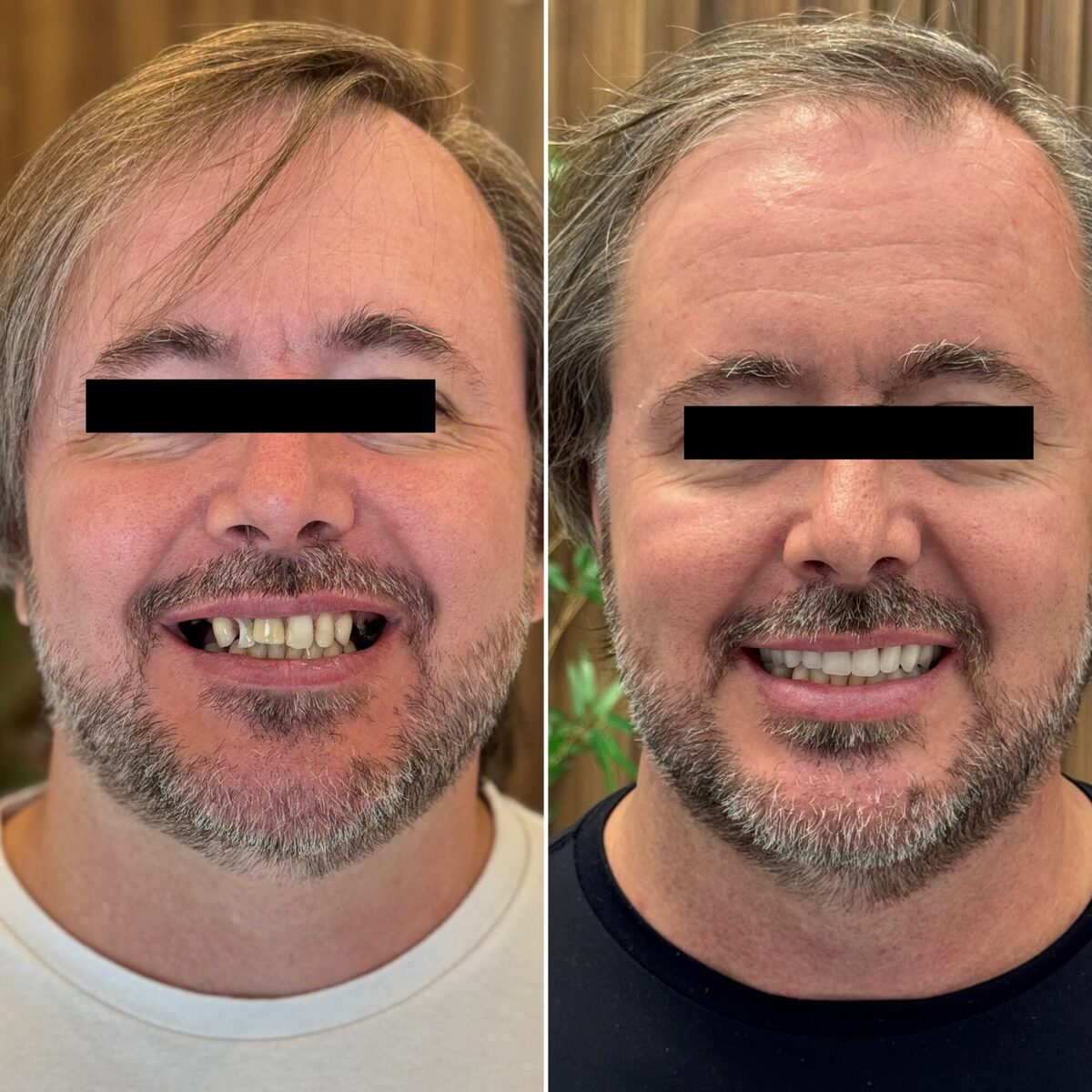Protocolo sobre implante — antes e depois do sorriso de um paciente, Dr. Carlos Miranda