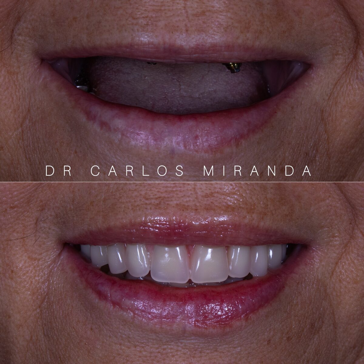 Protocolo sobre implante — arcada reabilitada, antes e depois, Dr. Carlos Miranda