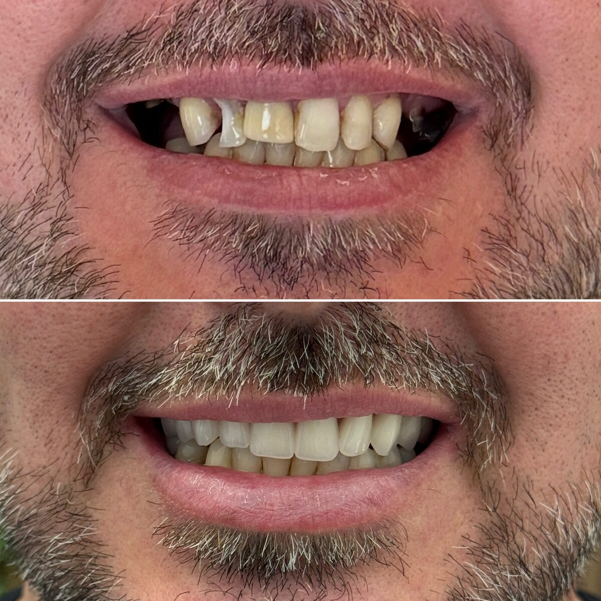 Protocolo sobre implante — sorriso restaurado, antes e depois, Dr. Carlos Miranda