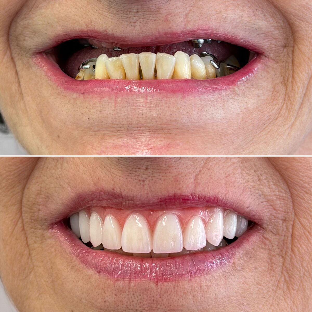 Protocolo sobre implante — antes e depois do sorriso, Dr. Carlos Miranda