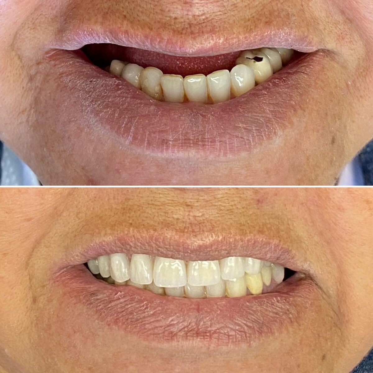 Protocolo sobre implante — sorriso reabilitado, antes e depois, Dr. Carlos Miranda