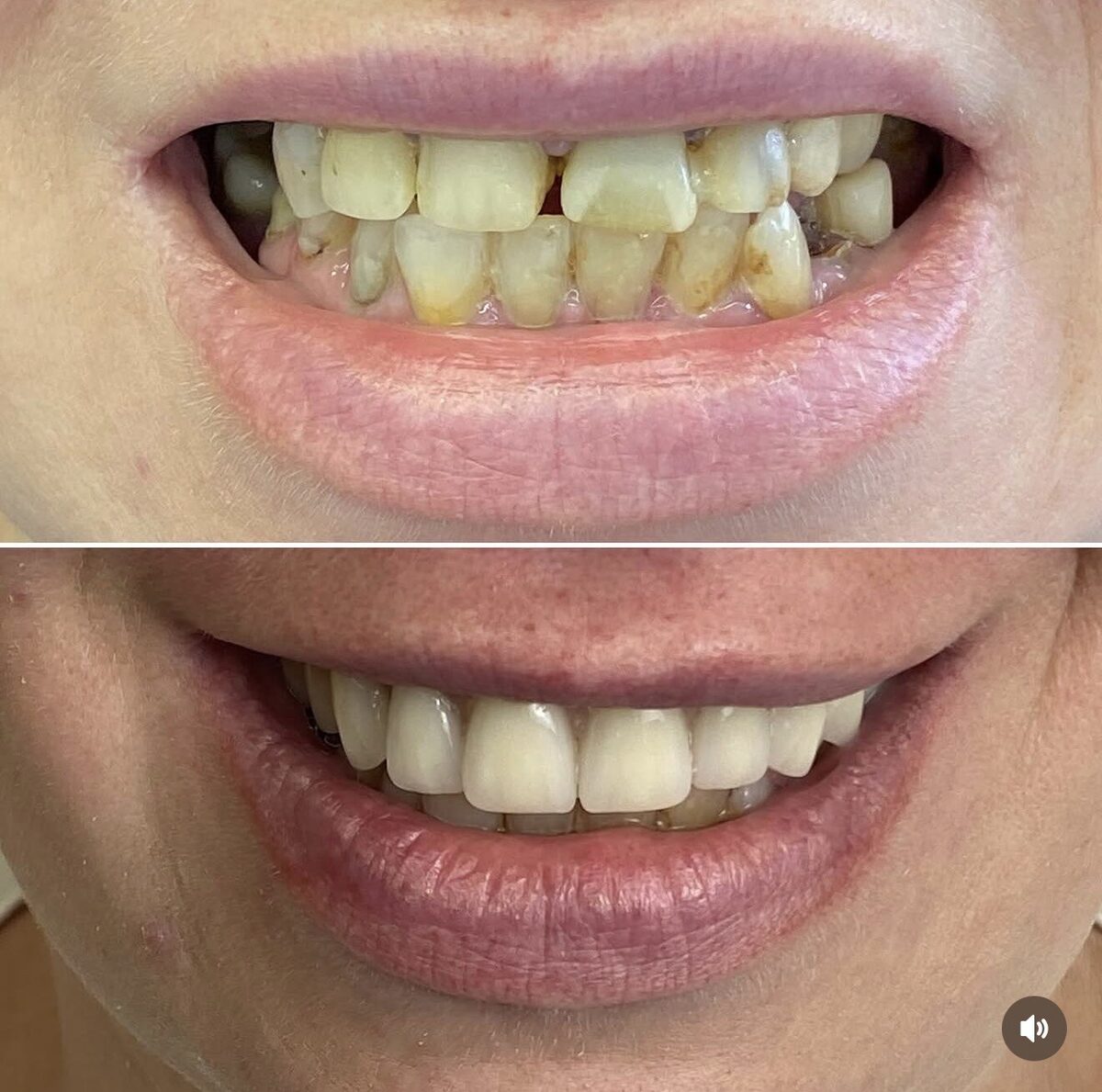 Protocolo sobre implante — detalhe do antes e depois dos dentes, Dr. Carlos Miranda